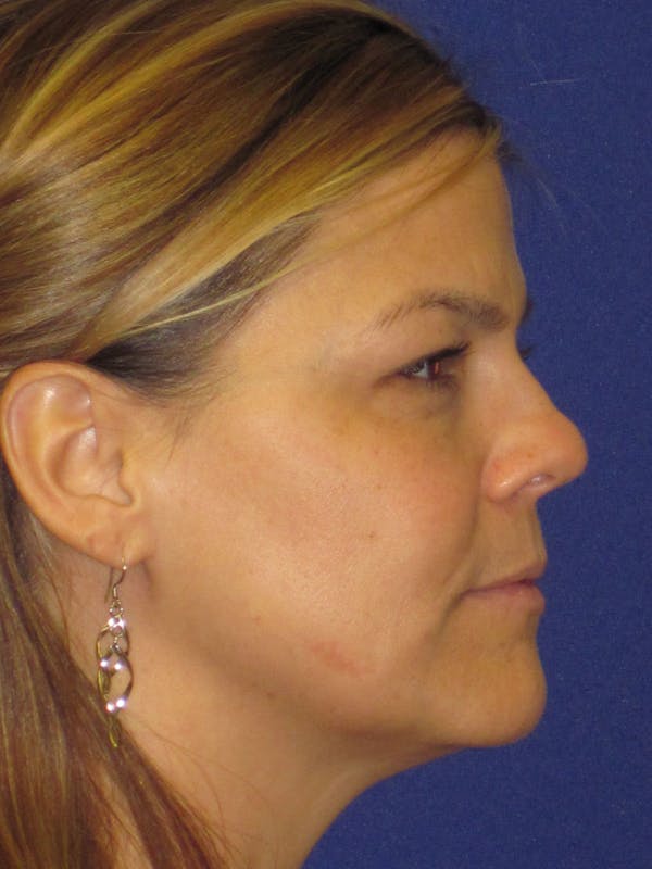 Rhinoplasty Before & After Gallery - Patient 4891334 - Image 5