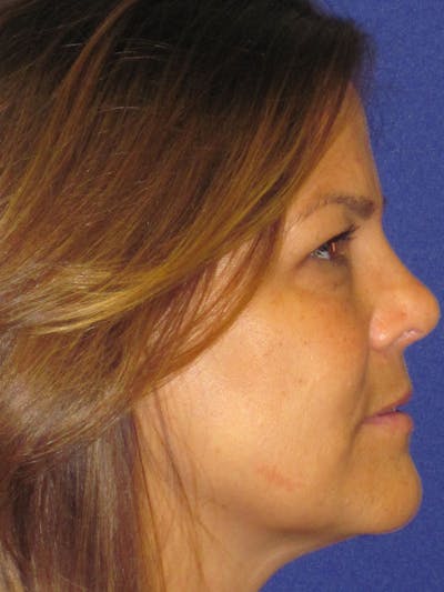 Rhinoplasty Before & After Gallery - Patient 4891334 - Image 6