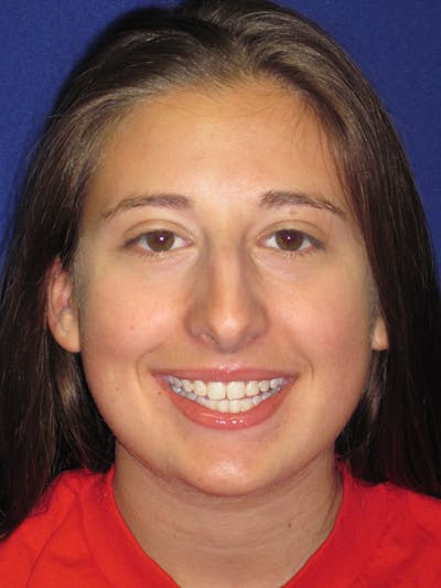 Rhinoplasty Before & After Gallery - Patient 4891337 - Image 1