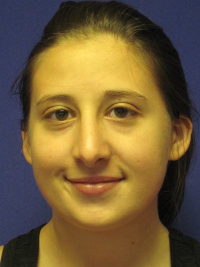 Rhinoplasty Before & After Gallery - Patient 4891337 - Image 2