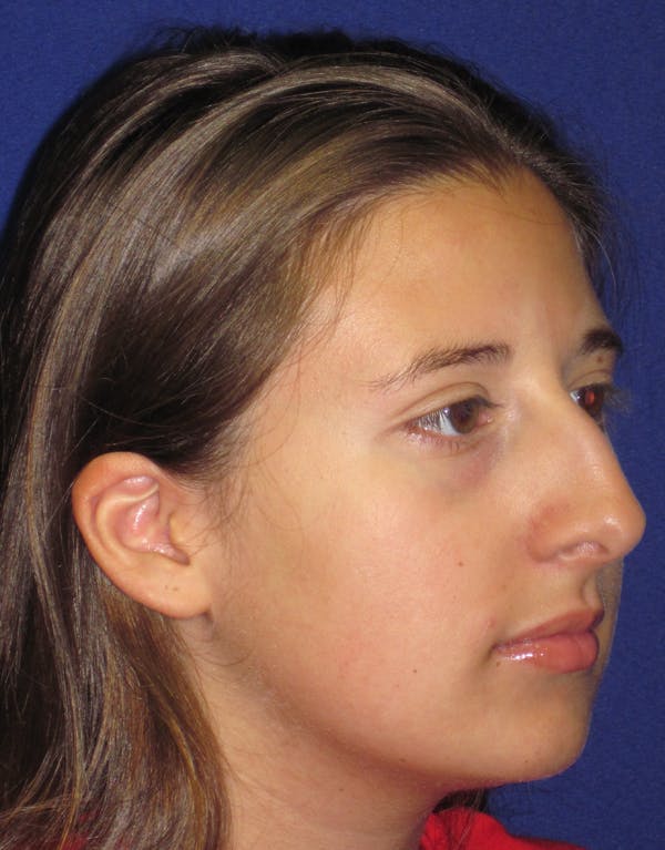 Rhinoplasty Before & After Gallery - Patient 4891337 - Image 3