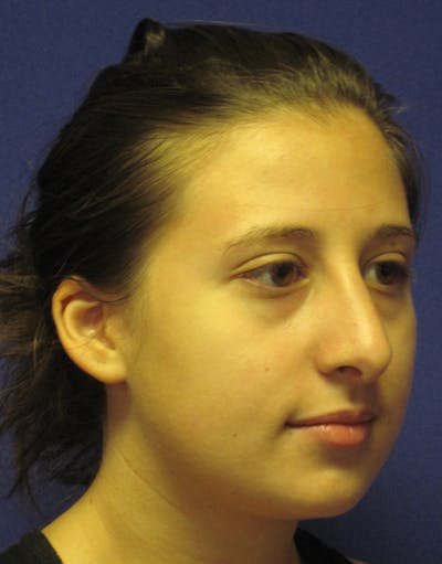 Rhinoplasty Before & After Gallery - Patient 4891337 - Image 4