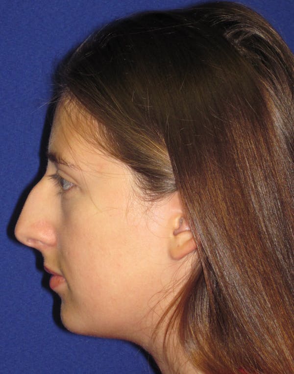 Rhinoplasty Before & After Gallery - Patient 4891337 - Image 5