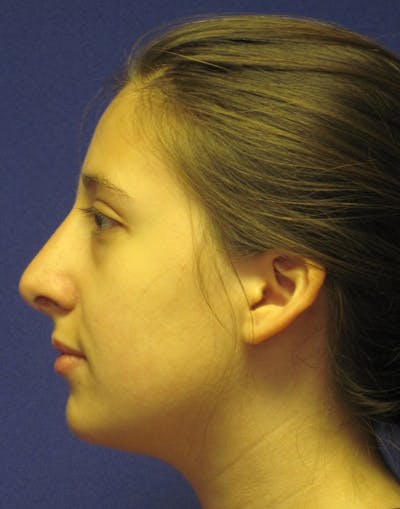 Rhinoplasty Before & After Gallery - Patient 4891337 - Image 6