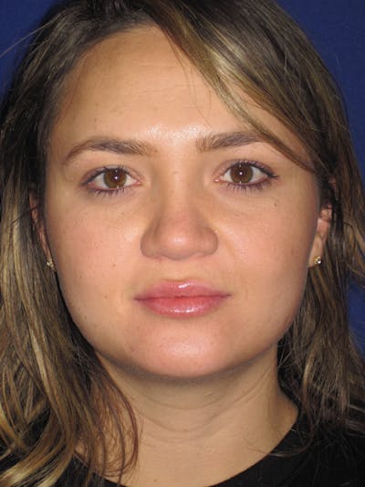 Rhinoplasty Before & After Gallery - Patient 4891342 - Image 1