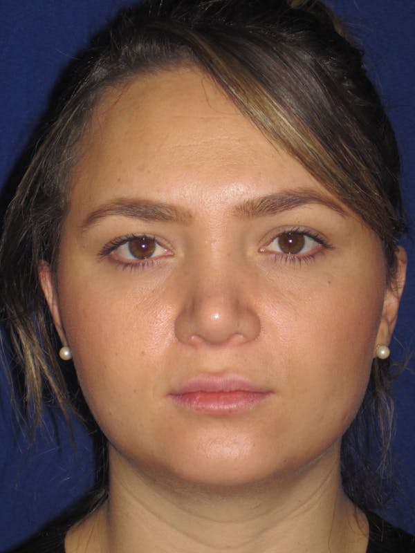 Rhinoplasty Before & After Gallery - Patient 4891342 - Image 2