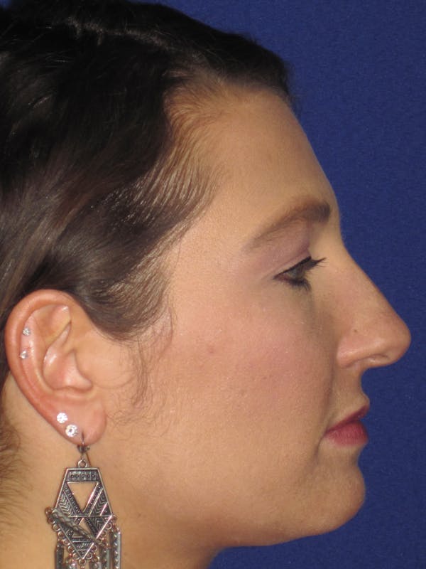 Rhinoplasty Before & After Gallery - Patient 4891349 - Image 3