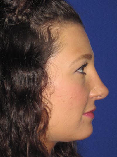 Rhinoplasty Before & After Gallery - Patient 4891349 - Image 4