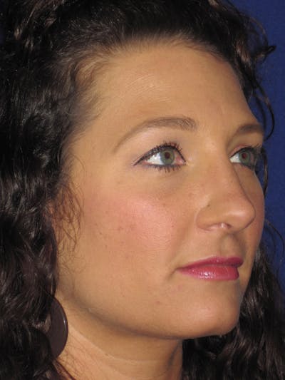 Rhinoplasty Before & After Gallery - Patient 4891349 - Image 6