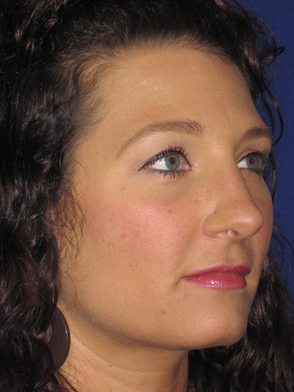 Rhinoplasty Gallery - Patient 4891349 - Image 6