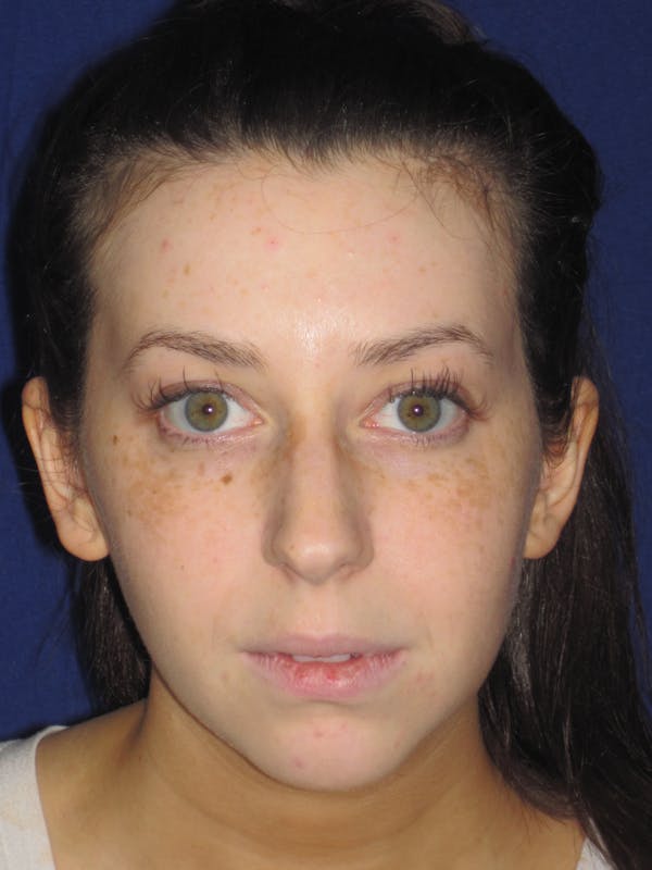 Rhinoplasty Before & After Gallery - Patient 4891356 - Image 1