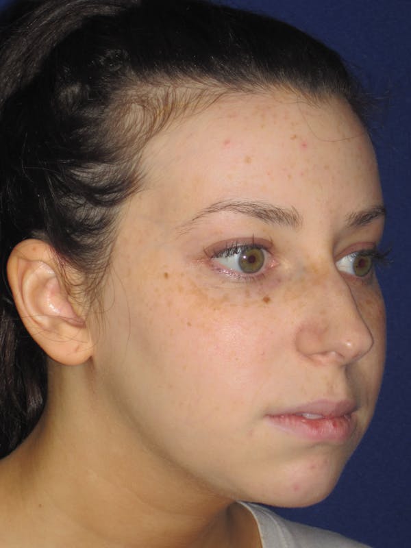 Rhinoplasty Before & After Gallery - Patient 4891356 - Image 3