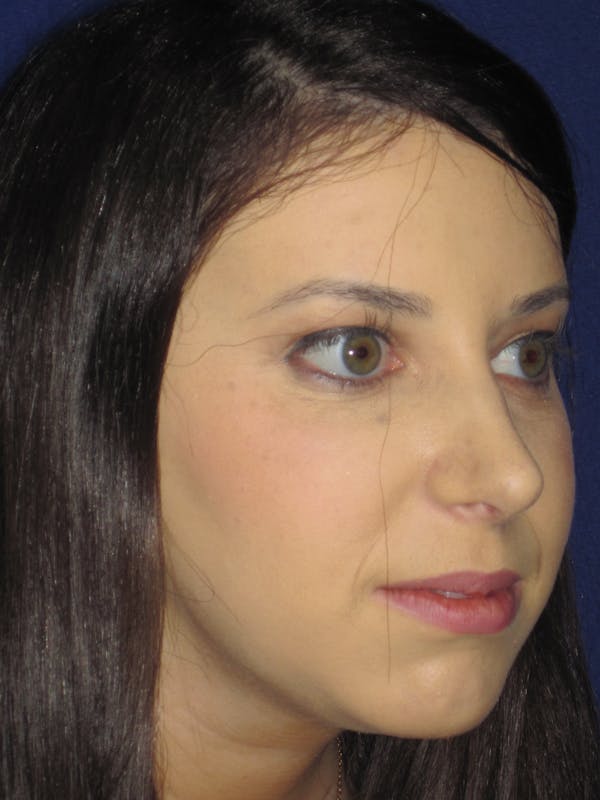 Rhinoplasty Before & After Gallery - Patient 4891356 - Image 4