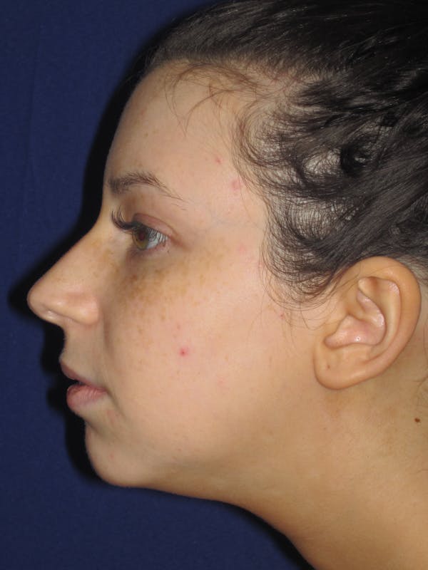Rhinoplasty Before & After Gallery - Patient 4891356 - Image 5