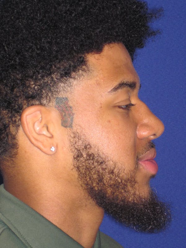 Rhinoplasty Gallery - Patient 4891365 - Image 3