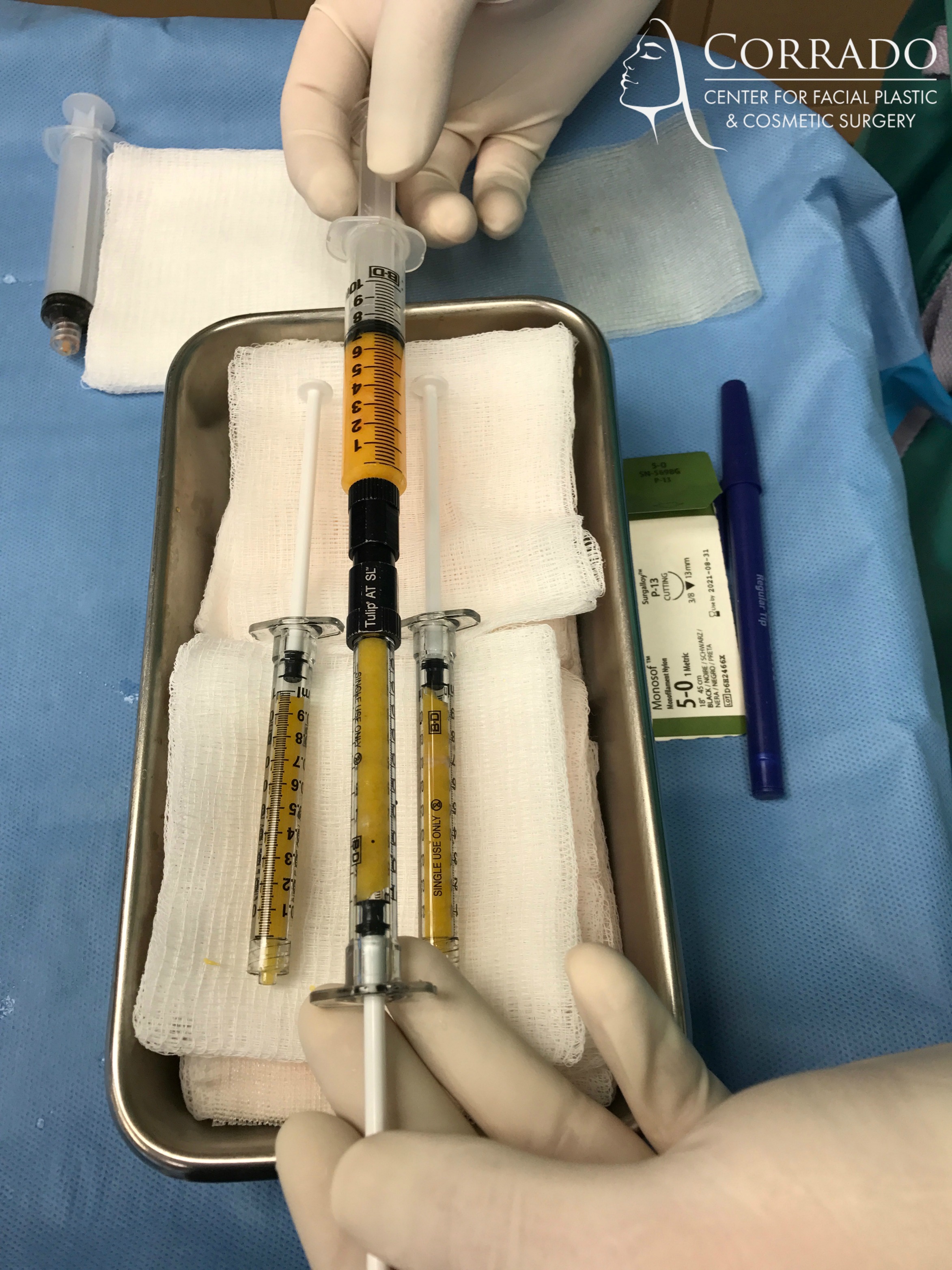 Facial Fat Transfer
