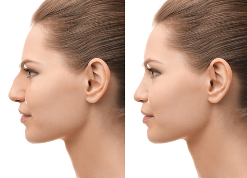 Benefits of a rhinoplasty