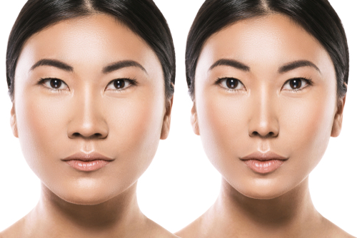 asian rhinoplasty