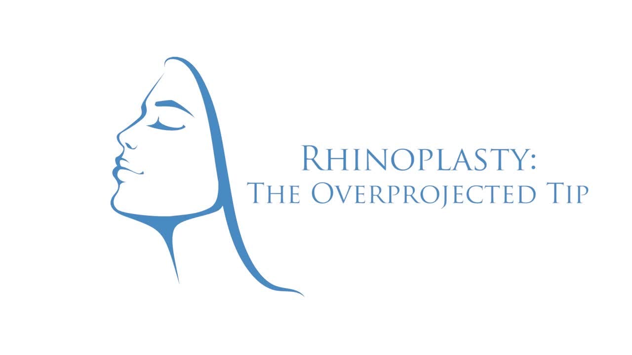 Rhinoplasty - The Overprojected Tip