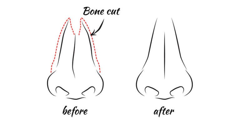 Before and After Infographic