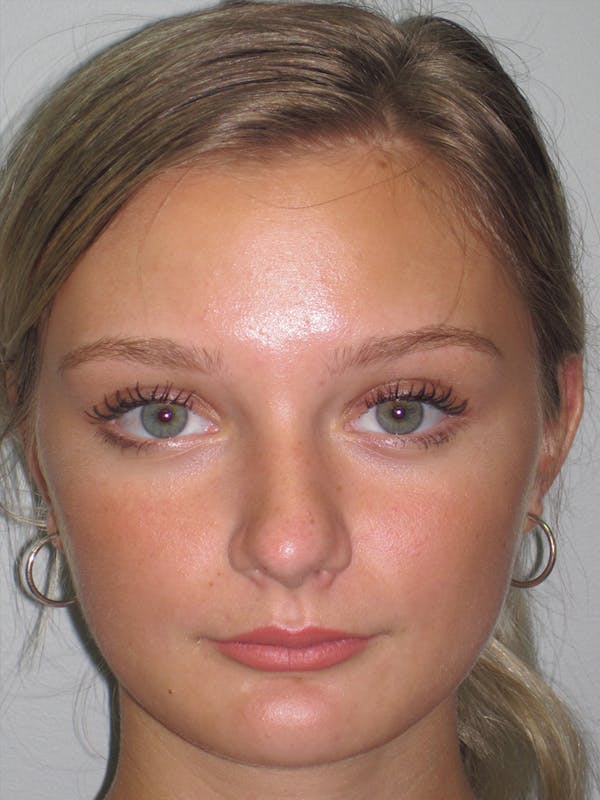 Rhinoplasty Before & After Gallery - Patient 11109877 - Image 3