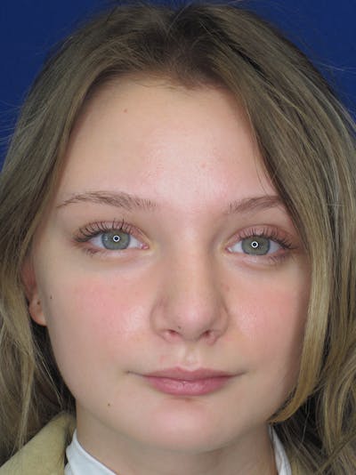 Rhinoplasty Before & After Gallery - Patient 11109877 - Image 4