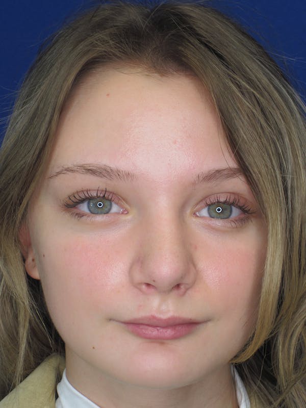 Rhinoplasty Before & After Gallery - Patient 11109877 - Image 4