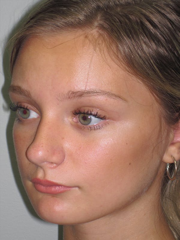 Rhinoplasty Before & After Gallery - Patient 11109877 - Image 1
