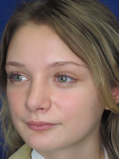 Rhinoplasty Before & After Gallery - Patient 11109877 - Image 2