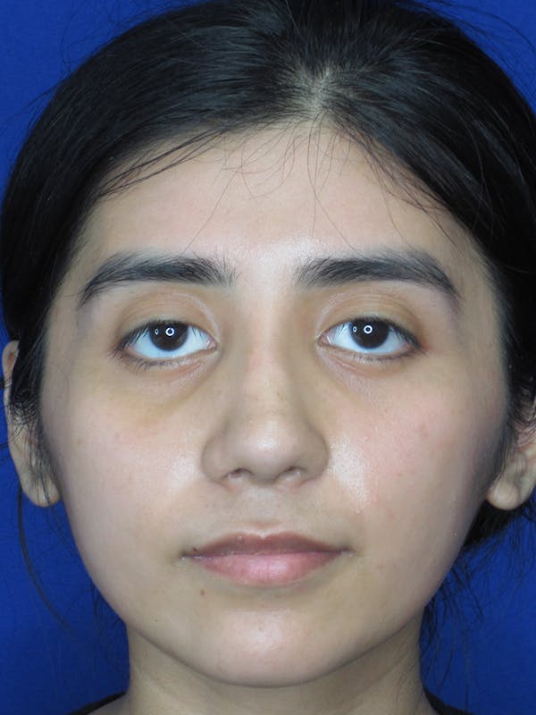 Rhinoplasty Before & After Gallery - Patient 11109878 - Image 2