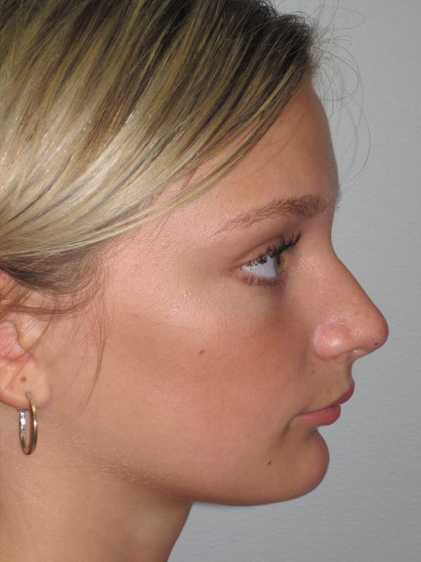 Rhinoplasty Before & After Gallery - Patient 11109877 - Image 5