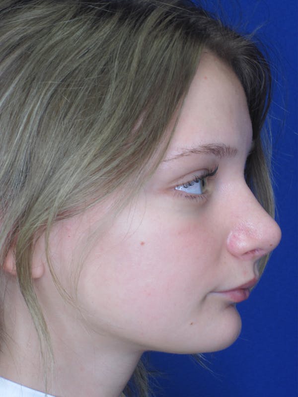 Rhinoplasty Before & After Gallery - Patient 11109877 - Image 6