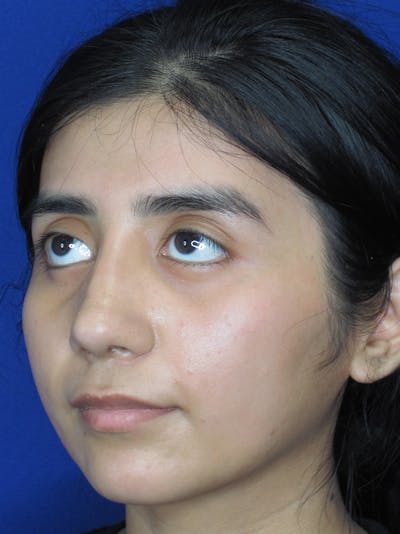 Rhinoplasty Before & After Gallery - Patient 11109878 - Image 6