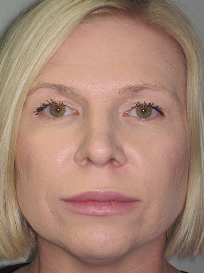 Rhinoplasty Before & After Gallery - Patient 11109879 - Image 2