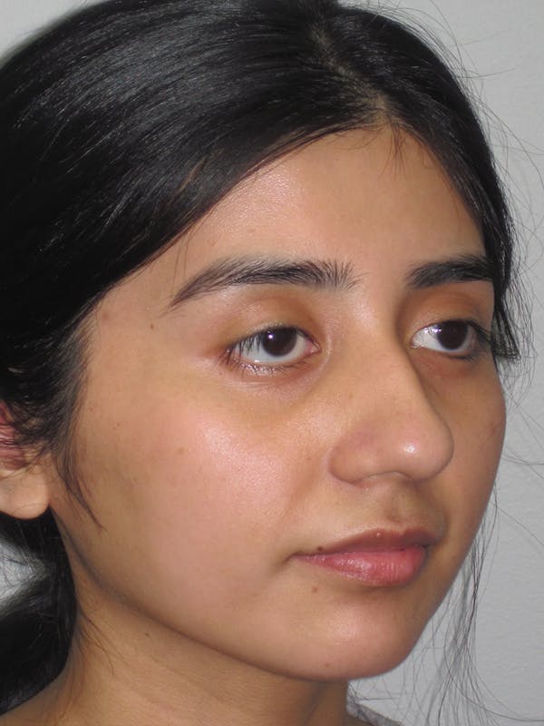 Rhinoplasty Gallery - Patient 11109878 - Image 3