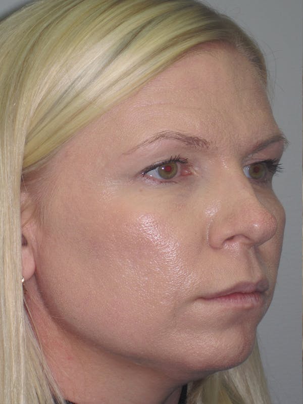 Rhinoplasty Before & After Gallery - Patient 11109879 - Image 5