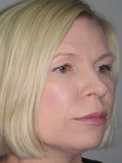 Rhinoplasty Before & After Gallery - Patient 11109879 - Image 6