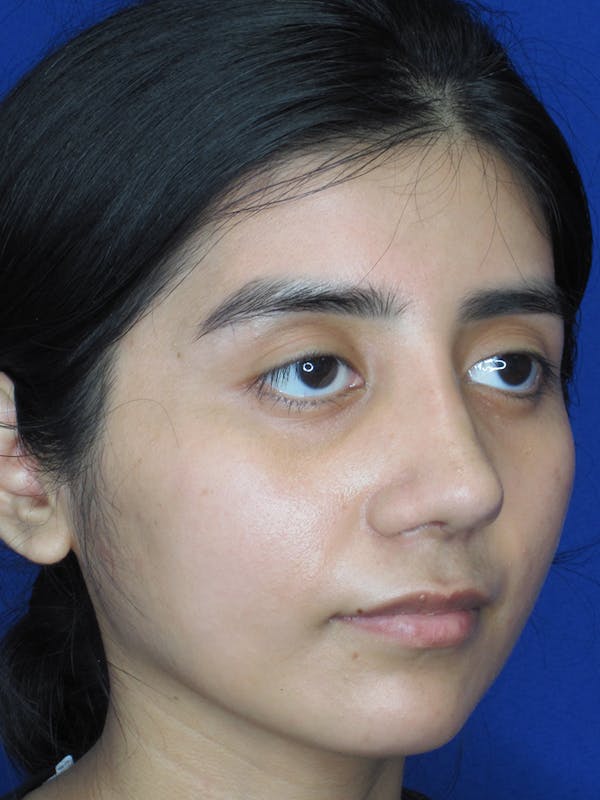 Rhinoplasty Before & After Gallery - Patient 11109878 - Image 4