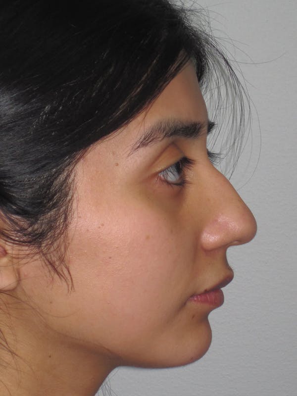 Rhinoplasty Before & After Gallery - Patient 11109878 - Image 7