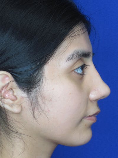 Rhinoplasty Before & After Gallery - Patient 11109878 - Image 8