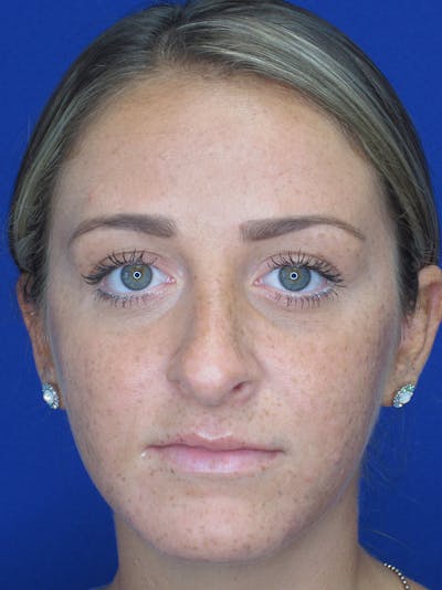 Rhinoplasty Before & After Gallery - Patient 11109880 - Image 1