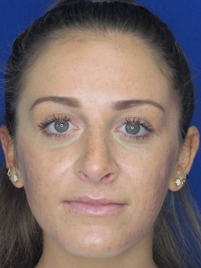 Rhinoplasty Before & After Gallery - Patient 11109880 - Image 2