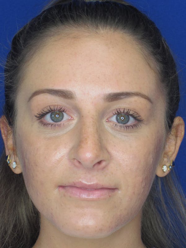 Rhinoplasty Before & After Gallery - Patient 11109880 - Image 2