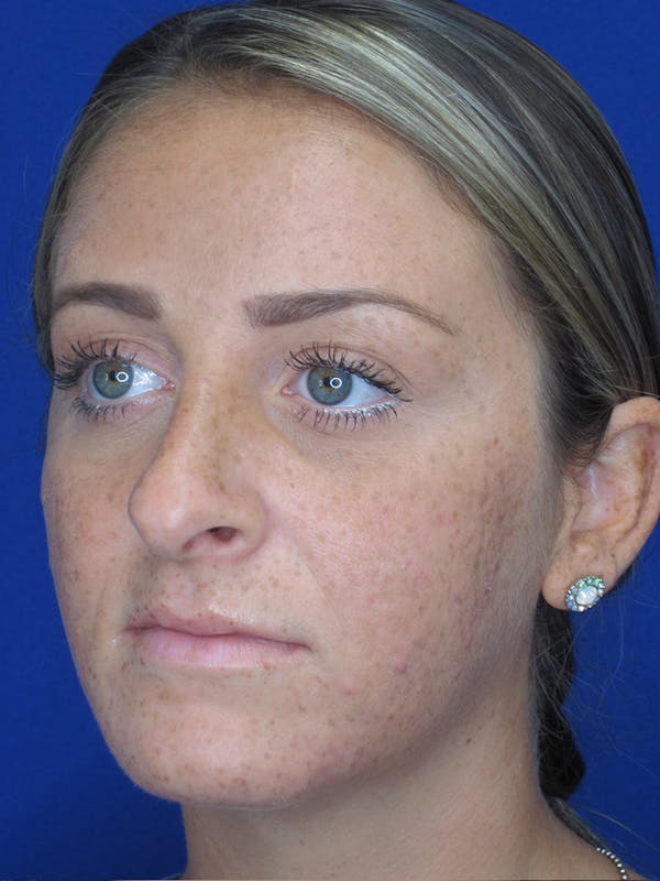 Rhinoplasty Before & After Gallery - Patient 11109880 - Image 5