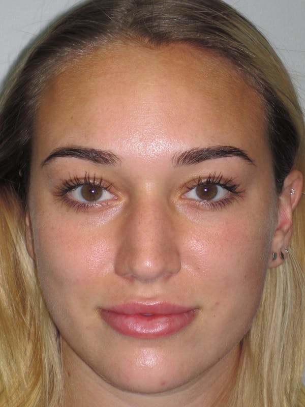 Rhinoplasty Before & After Gallery - Patient 11109881 - Image 3