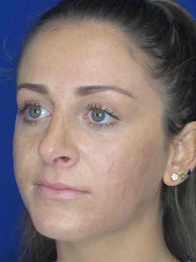 Rhinoplasty Before & After Gallery - Patient 11109880 - Image 6