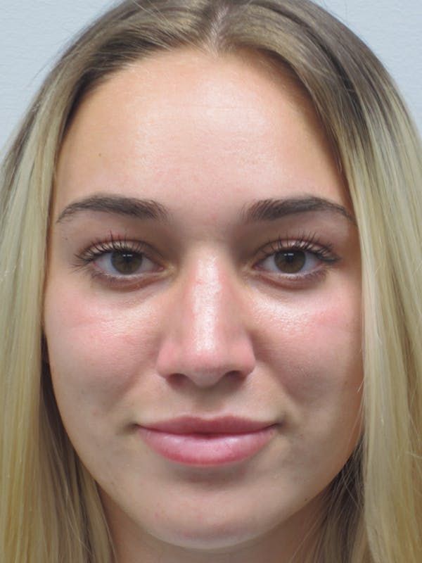 Rhinoplasty Before & After Gallery - Patient 11109881 - Image 4