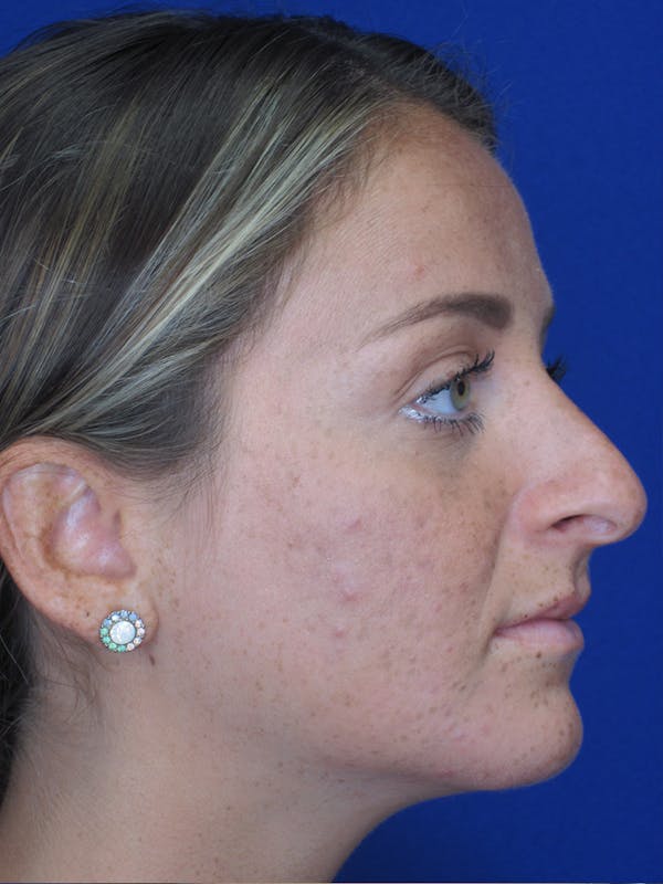 Rhinoplasty Before & After Gallery - Patient 11109880 - Image 3