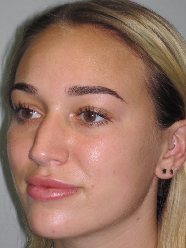 Rhinoplasty Before & After Gallery - Patient 11109881 - Image 5