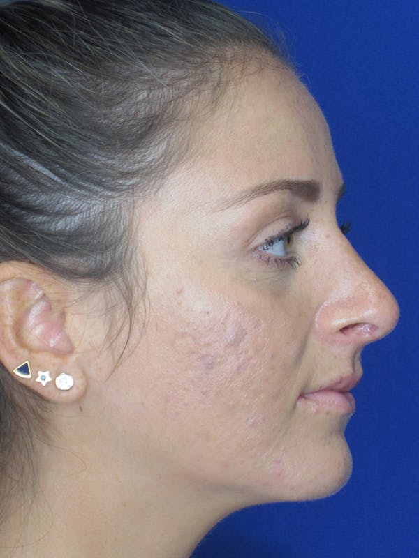 Rhinoplasty Before & After Gallery - Patient 11109880 - Image 4